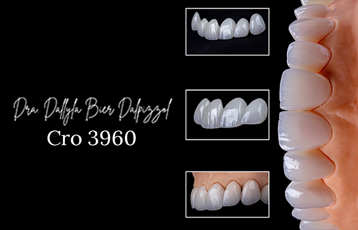 Facetas em Porcelana